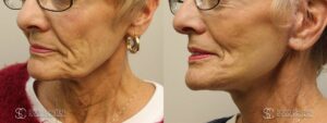 Facelift Before and After Photo - Patient 2B
