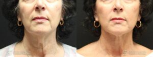 Facelift Before and After Photo - Patient 3A