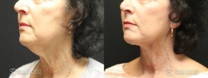 Facelift Before and After Photo - Patient 3B