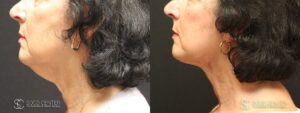 Facelift Before and After Photo - Patient 3C