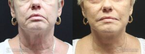 Facelift Before and After Photo - Patient 4A
