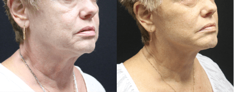 Facelift Before & After Gallery Section Photo