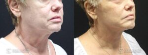 Facelift Before and After Photo - Patient 4B