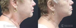 Facelift Before and After Photo - Patient 4C