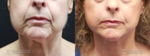 Facelift Before and After Photo - Patient 5A