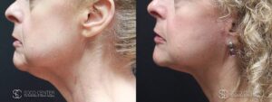 Facelift Before and After Photo - Patient 5B