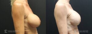 Breast Before and After Photo - Patient 7B