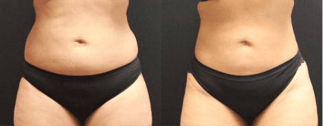 Liposuction Before & After Gallery Section Photo