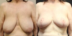 Breast Before and After Photo - Patient 3A