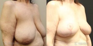 Breast Before and After Photo - Patient 3C