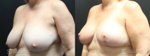Breast Before and After Photo - Patient 4B