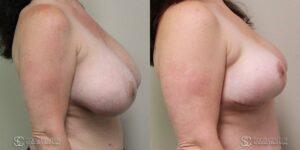 Breast Before and After Photo - Patient 5B
