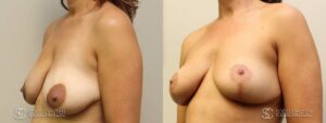 Breast Before and After Photo - Patient 6B