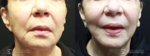 Mini Facelift Before and After Photo - Patient 2A
