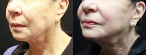 Mini Facelift Before and After Photo - Patient 2B
