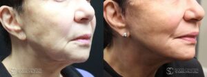 Mini Facelift Before and After Photo - Patient 2C