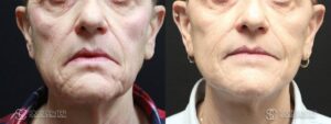 Mini Facelift Before and After Photo - Patient 3A