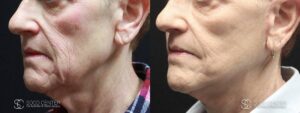 Mini Facelift Before and After Photo - Patient 3B
