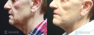 Mini Facelift Before and After Photo - Patient 3C
