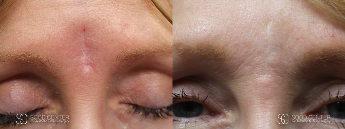 Scar Revision Before and After Photo - Forehead