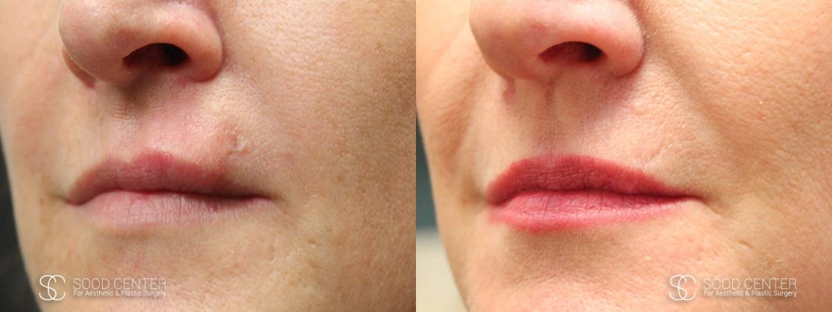 Scar Revision Before and After Photo - Upper Lip