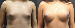 Breast Augmentation for Transgender Woman Before & After Photo - 1A