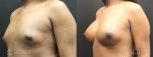 Breast Augmentation for Transgender Woman Before & After Photo - 1B