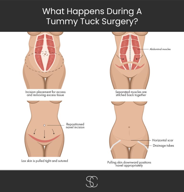 Learn more about what’s involved in a tummy tuck procedure at Linwood and Haddonfield’s Sood Center.